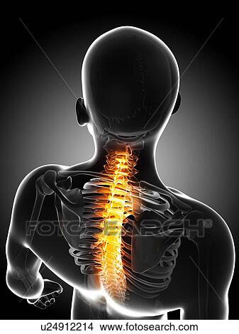 Stock Illustration - Back pain, conceptual artwork. Fotosearch