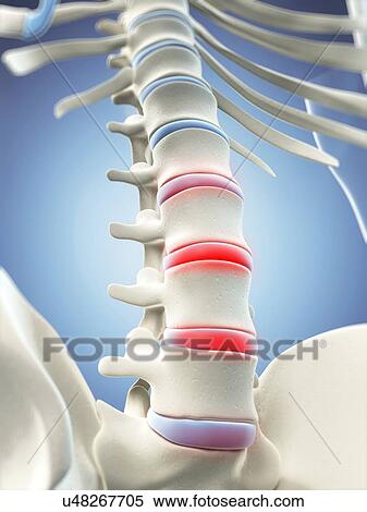 Stock Illustration - Back pain, conceptual artwork. Fotosearch