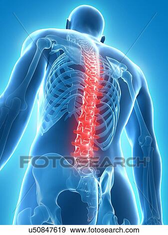 Back pain, conceptual artwork View Large Illustration Stock Illustration - Back pain, conceptual artwork. Fotosearch