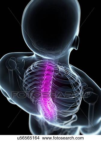 Stock Illustration - Back pain, conceptual artwork. Fotosearch