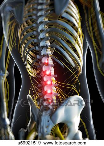 Back pain, conceptual artwork View Large Illustration Stock Illustration - Back pain, conceptual artwork. Fotosearch