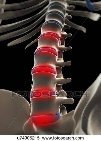 Stock Illustration - Back pain, conceptual artwork. Fotosearch
