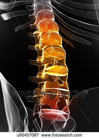 Back pain, conceptual artwork View Large Illustration Stock Illustration - Back pain, conceptual artwork. Fotosearch
