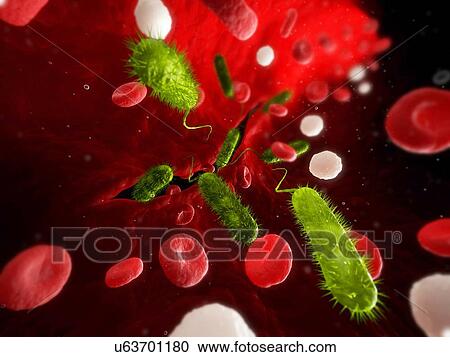 Clipart - Bacterial infection, artwork. Fotosearch