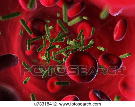 Bacterial infection, artwork View Large Illustration Drawing - Bacterial infection, artwork. Fotosearch