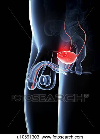 Bladder cancer, artwork View Large Illustration Drawing - Bladder cancer, artwork. Fotosearch