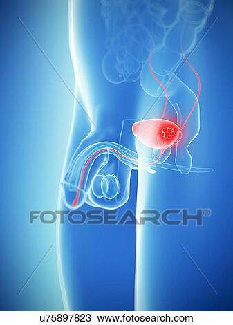 Bladder cancer, artwork View Large Illustration Drawing - Bladder cancer, artwork. Fotosearch