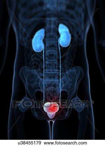 Stock Illustration - Bladder cancer, artwork. Fotosearch