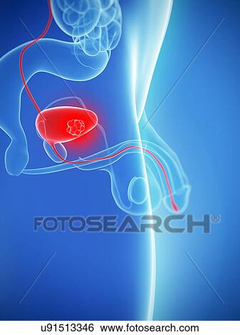 Bladder cancer, artwork View Large Illustration Stock Illustration - Bladder cancer, artwork. Fotosearch