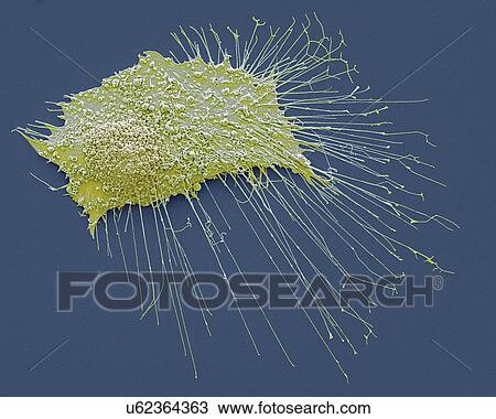Bone cancer cell, SEM View Large Illustration Drawing - Bone cancer cell, SEM. Fotosearch