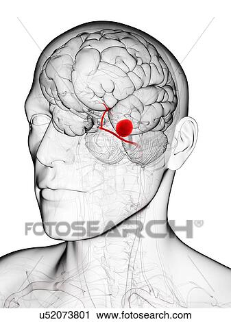 Clip Art - Brain aneurysm, artwork. Fotosearch