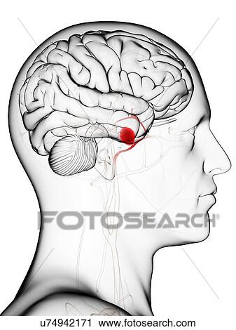 Clip Art - Brain aneurysm, artwork. Fotosearch