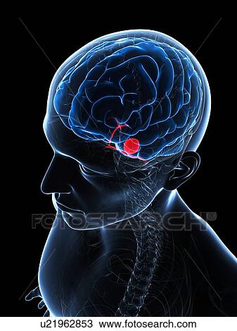 Brain aneurysm, artwork View Large Illustration Drawing - Brain aneurysm, artwork. Fotosearch