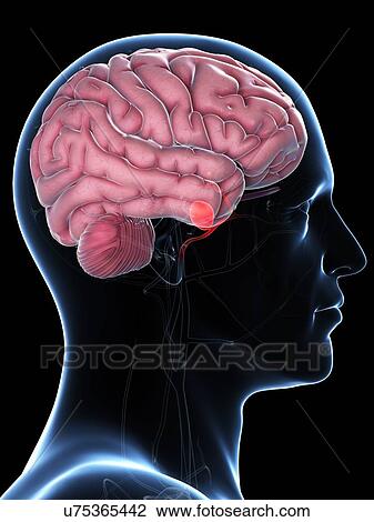 Brain aneurysm, artwork View Large Illustration Drawing - Brain aneurysm, artwork. Fotosearch