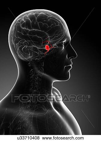 Brain aneurysm, artwork View Large Illustration Stock Illustration - Brain aneurysm, artwork. Fotosearch
