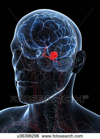 Stock Illustration - Brain aneurysm, artwork. Fotosearch