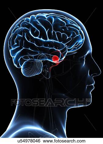 Brain aneurysm, artwork View Large Illustration Stock Illustration - Brain aneurysm, artwork. Fotosearch
