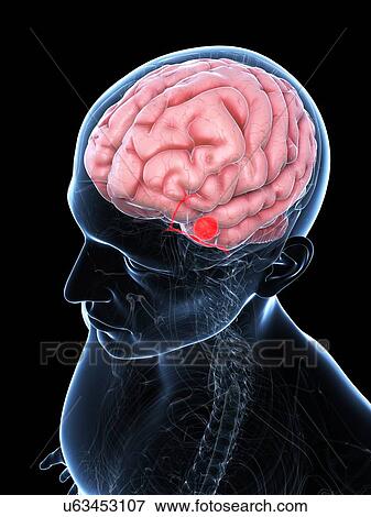 Brain aneurysm, artwork View Large Illustration Stock Illustration - Brain aneurysm, artwork. Fotosearch
