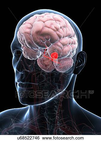 Stock Illustration - Brain aneurysm, artwork. Fotosearch
