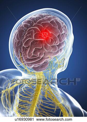Brain cancer, artwork View Large Illustration Clip Art - Brain cancer, artwork. Fotosearch