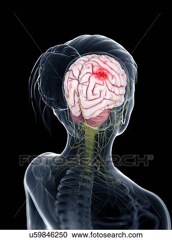 Clipart - Brain cancer, artwork. Fotosearch