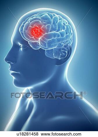 Stock Illustration - Brain cancer, artwork. Fotosearch