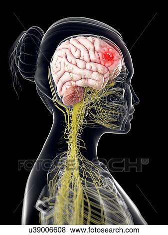 Brain cancer, artwork View Large Illustration Stock Illustration - Brain cancer, artwork. Fotosearch