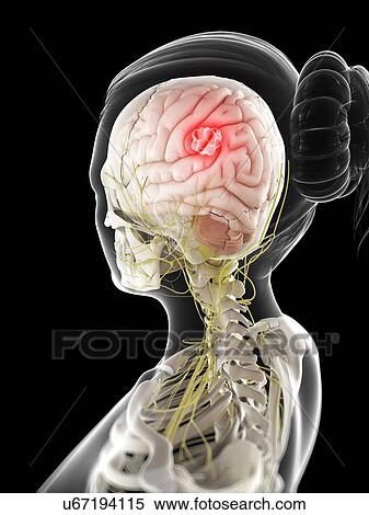 Stock Illustration - Brain cancer, artwork. Fotosearch