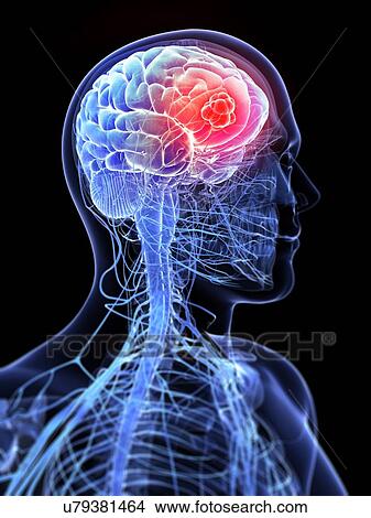 Stock Illustration - Brain cancer, artwork. Fotosearch