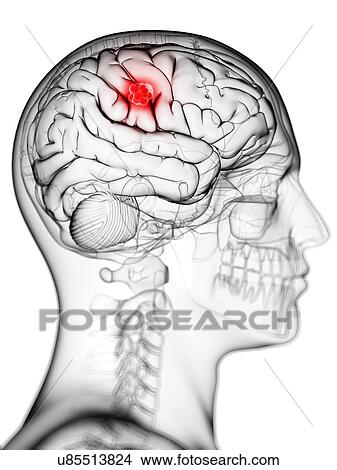 Stock Illustration - Brain cancer, artwork. Fotosearch