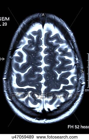 Brain scan, MRI scan View Large Illustration Stock Illustration - Brain scan, MRI scan. Fotosearch