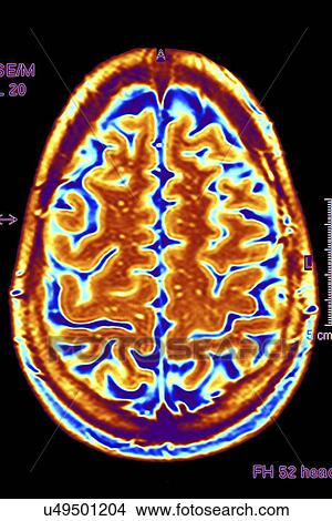 Stock Illustration - Brain scan, MRI scan. Fotosearch