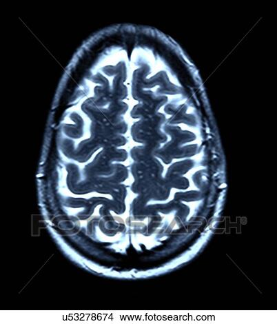 Stock Illustration - Brain scan, MRI scan. Fotosearch
