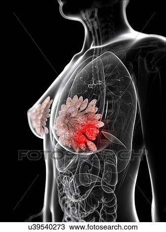 Drawing - Breast cancer, artwork. Fotosearch