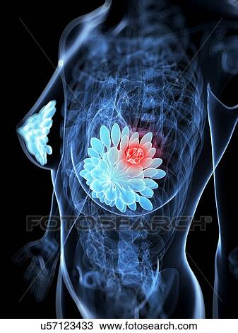 Drawing - Breast cancer, artwork. Fotosearch