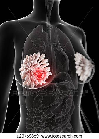 Stock Illustration - Breast cancer, artwork. Fotosearch