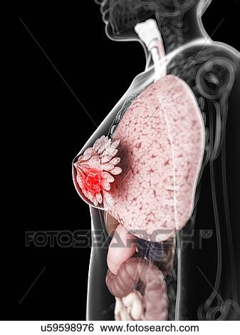 Stock Illustration - Breast cancer, artwork. Fotosearch