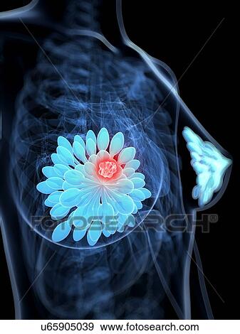 Stock Illustration - Breast cancer, artwork. Fotosearch