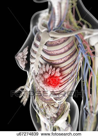 Stock Illustration - Breast cancer, artwork. Fotosearch