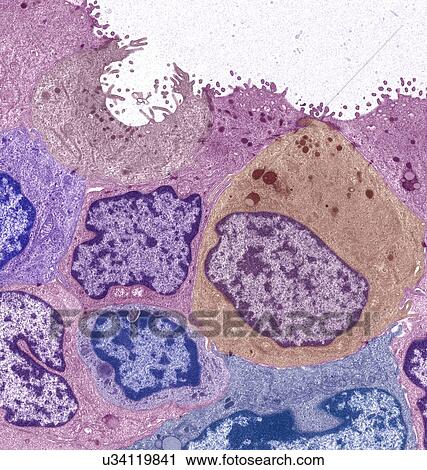 Breast cancer, TEM View Large Illustration Clip Art - Breast cancer, TEM. Fotosearch