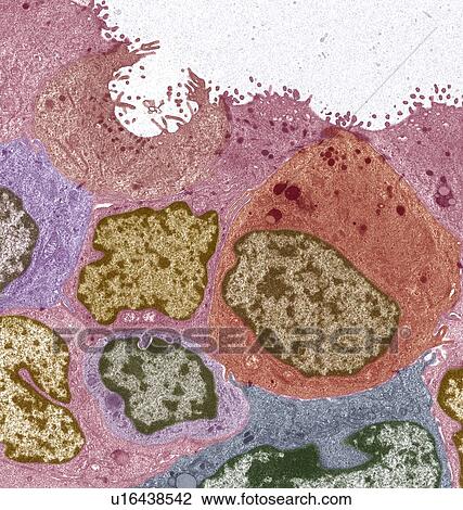 Drawing - Breast cancer, TEM. Fotosearch