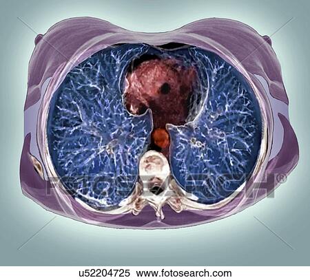 Stock Illustration - Chest anatomy, 3D CT scan. Fotosearch