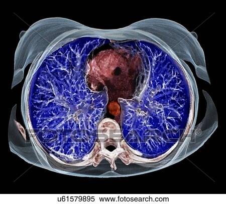 Chest anatomy, 3D CT scan View Large Illustration Stock Illustration - Chest anatomy, 3D CT scan. Fotosearch