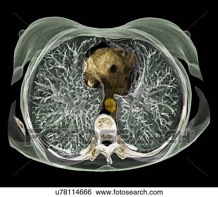 Stock Illustration - Chest anatomy, 3D CT scan. Fotosearch