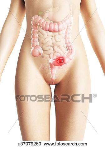 Colon cancer, artwork View Large Illustration Clipart - Colon cancer, artwork. Fotosearch