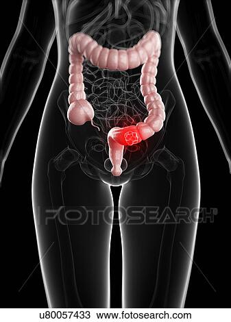 Drawing - Colon cancer, artwork. Fotosearch