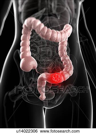Colon cancer, artwork View Large Illustration Stock Illustration - Colon cancer, artwork. Fotosearch