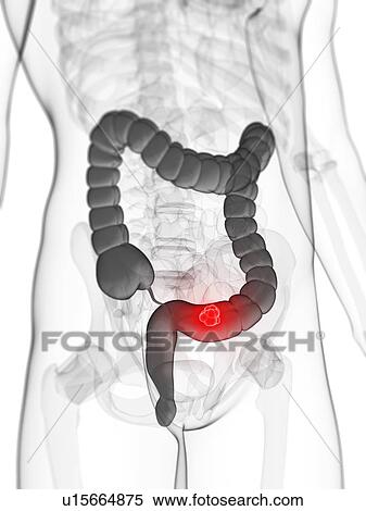 Stock Illustration - Colon cancer, artwork. Fotosearch