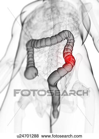 Colon cancer, artwork View Large Illustration Stock Illustration - Colon cancer, artwork. Fotosearch