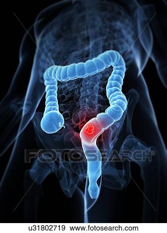 Colon cancer, artwork View Large Illustration Stock Illustration - Colon cancer, artwork. Fotosearch